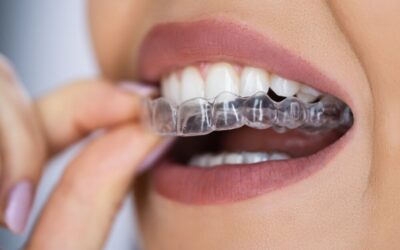 ¿Cuánto Dura la Ortodoncia Invisible?