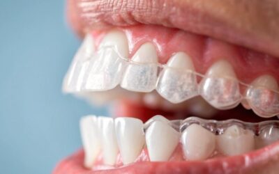 Ortodoncia Sin Extracciones En Costa Rica: FabSmile Aligners